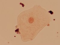Female cheek cell with Barr Body (inactive X)